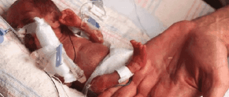 Imagen: El bebé más pequeño del mundo