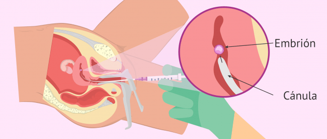 Imagen: Transferencia embrionaria