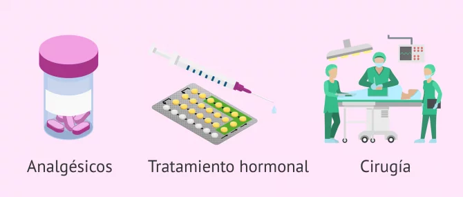 Imagen: Endometriosis y dolor de vientre