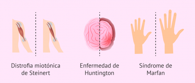 Imagen: Enfermedades genéticas autosómicas dominantes