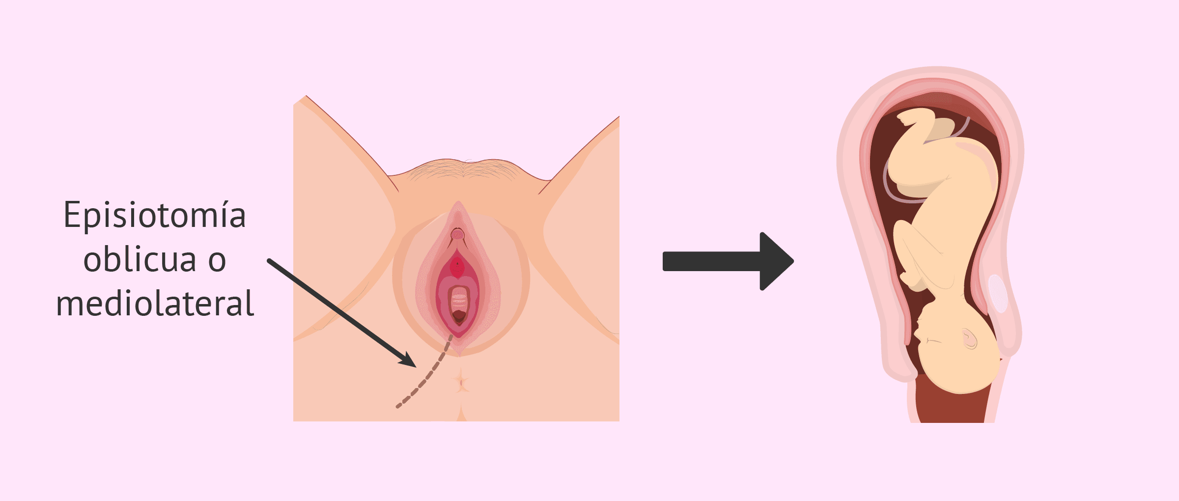 ¿Qué es la episiotomía y cómo puedo prevenirla en el parto?