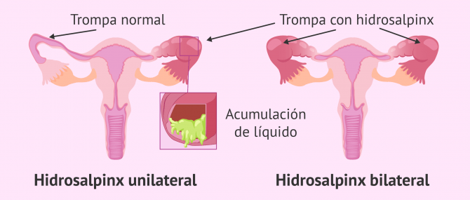 Imagen: Inflamación de las trompas