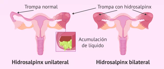Imagen: Inflamación de las trompas