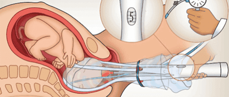 Invento para ayudar en el parto