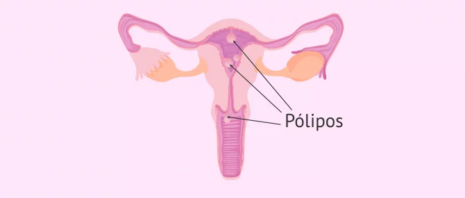 Imagen: Pólipo uterino