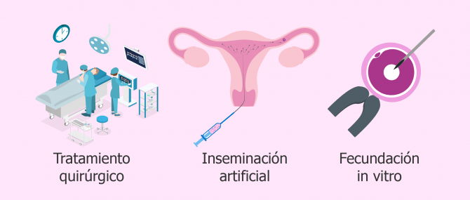 Imagen: Varicocele y embarazo