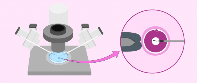Imagen: Microinyección del espermatozoide en el óvulo
