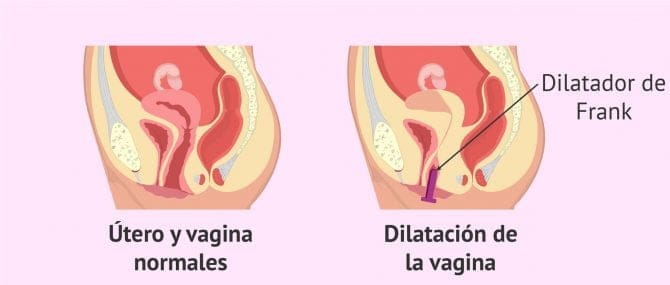 Imagen: Solución al síndrome Mayer-Rokitansky-Küster-Hauser