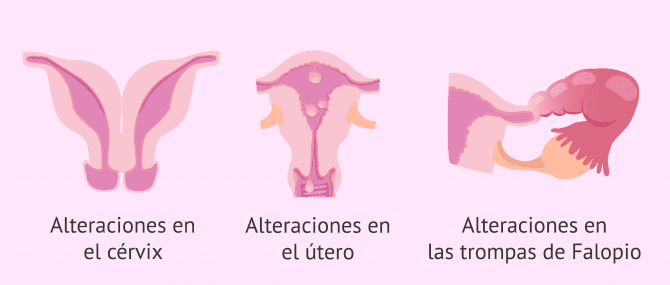 Imagen: Alteraciones que detecta la HSG