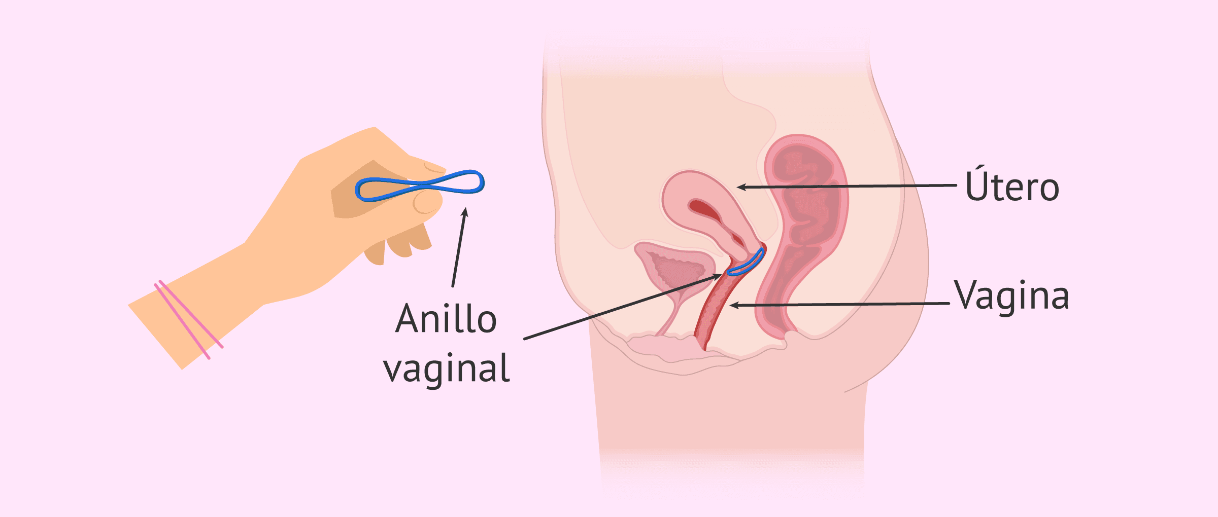 El anillo vaginal anticonceptivo y sus efectos secundarios