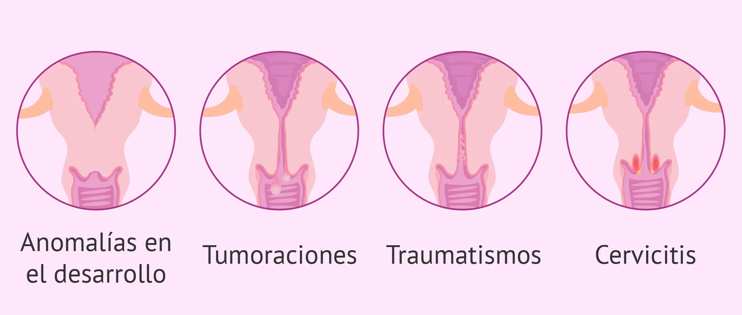 Factor cervical: esterilidad femenina por anomalías en el cérvix