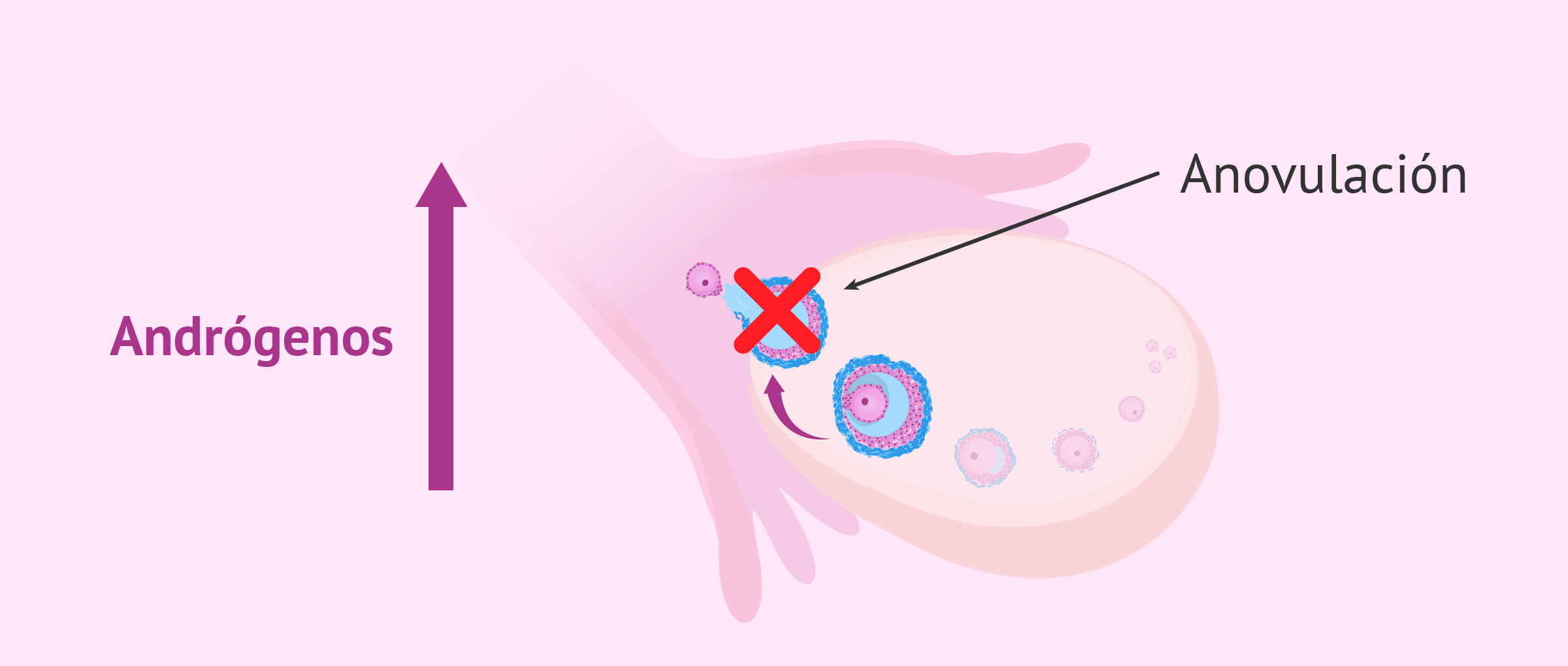 Fertilidad con el síndrome de ovarios poliquísticos (SOP)