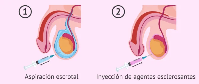 Imagen: Aspiración escrotal y escleroterapia
