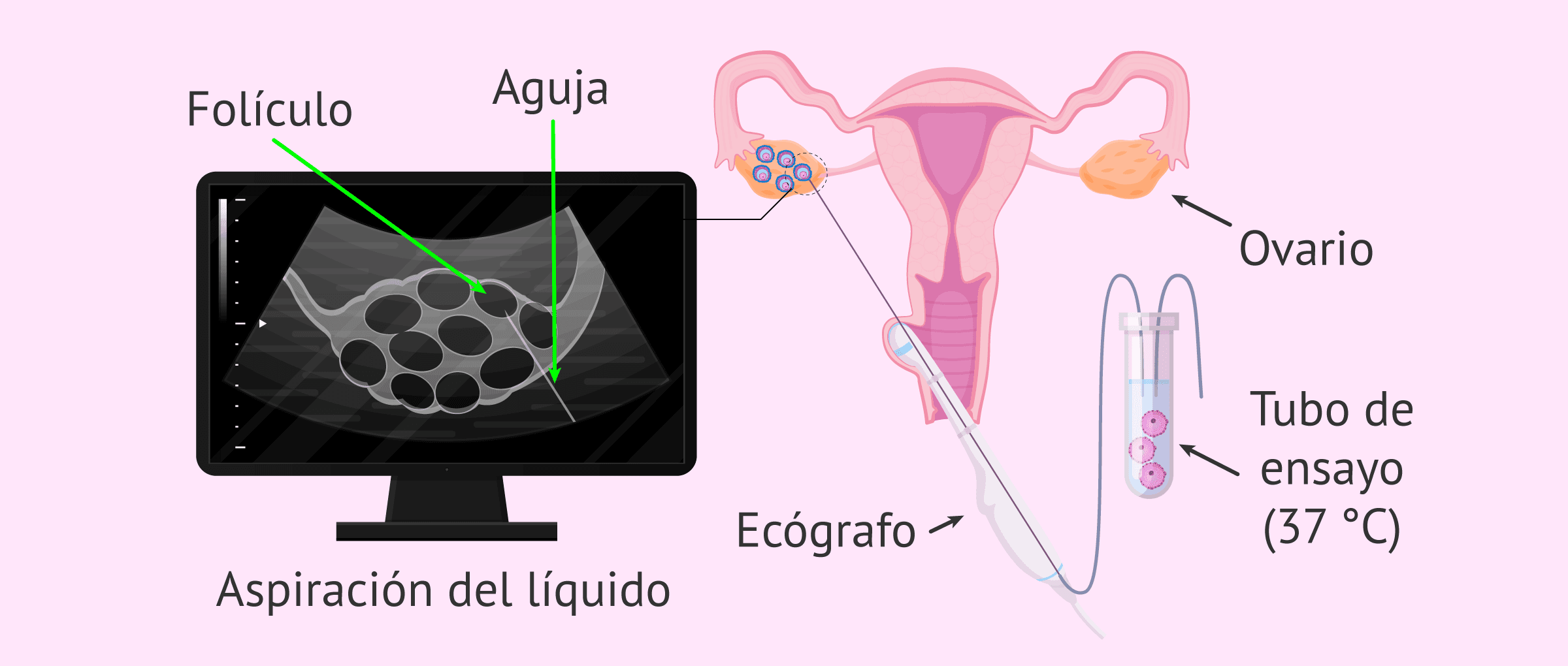 Imagen: Aspiración folicular o punción ovárica