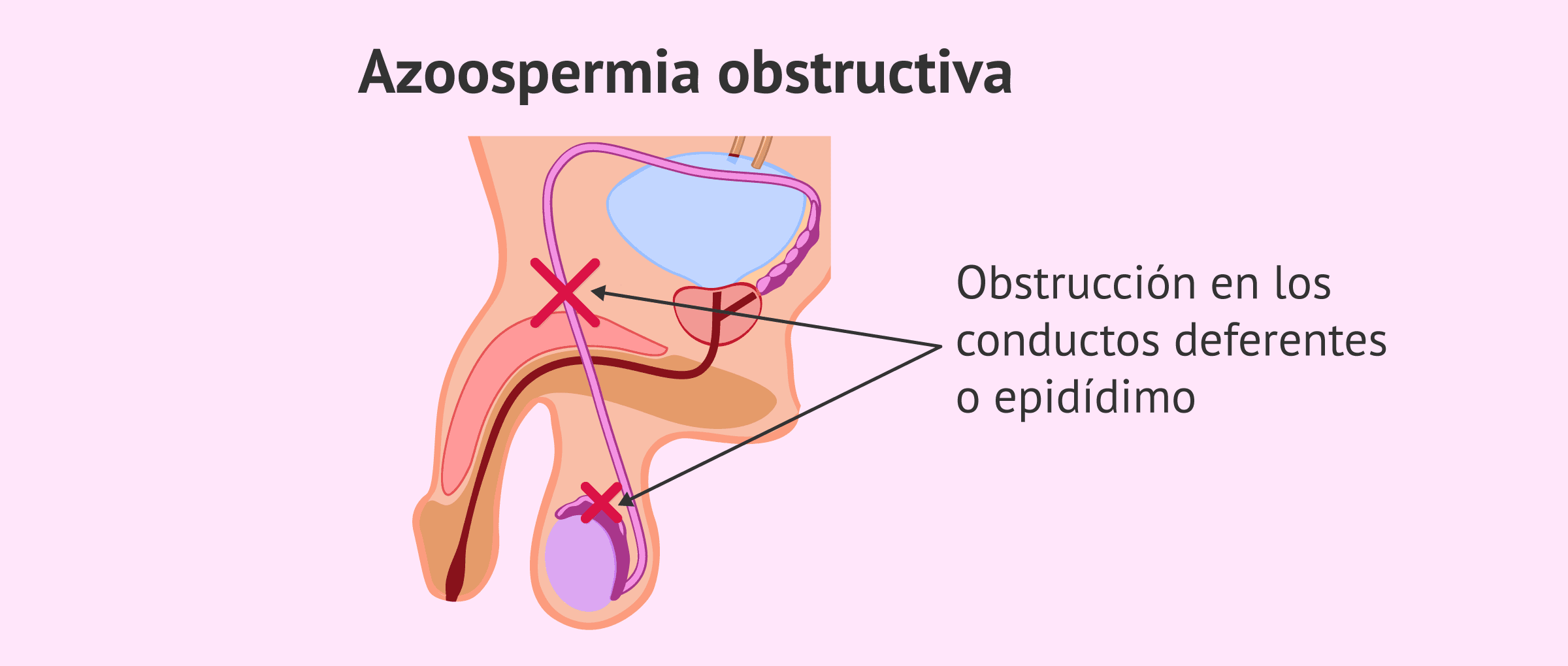 Imagen: Azoospermia obstructiva por bloqueo de los conductos seminales