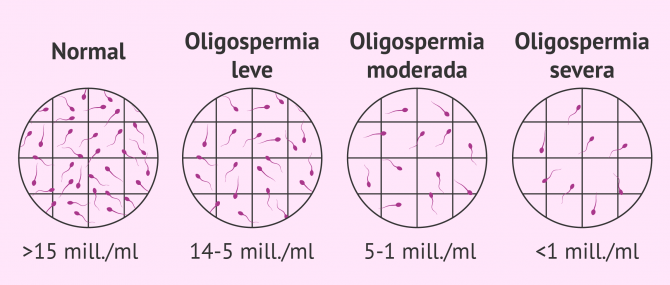 Imagen: Diagnosticar oligozoospermia