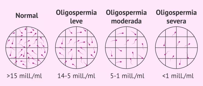Imagen: Diagnosticar oligozoospermia