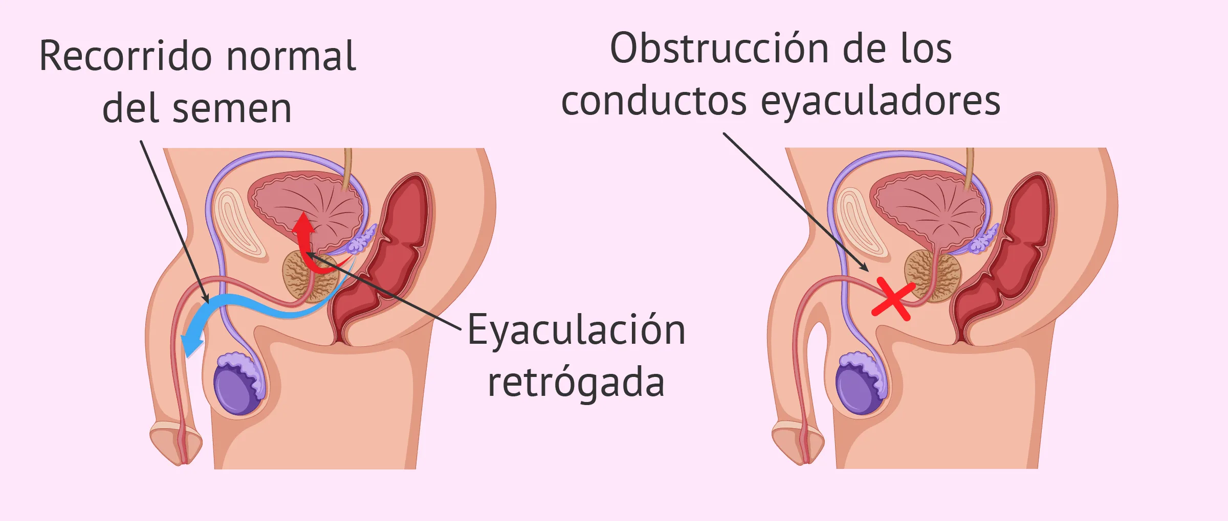 Causas de la aspermia