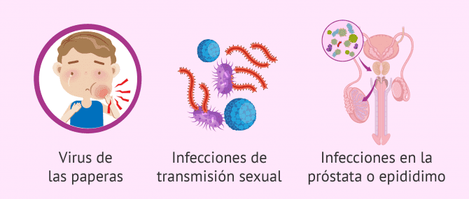 Imagen: Causas de la orquitis