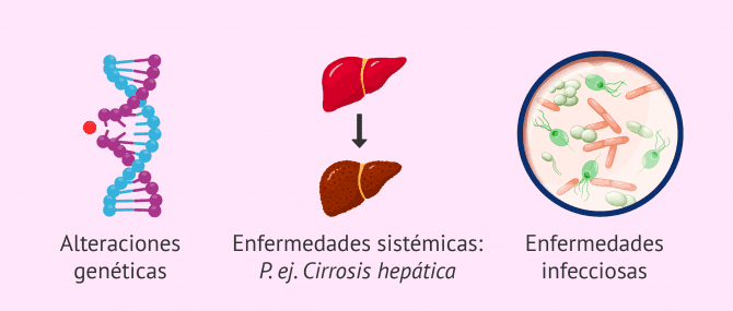 Imagen: Causas hipogonadismo hipergonadotropo