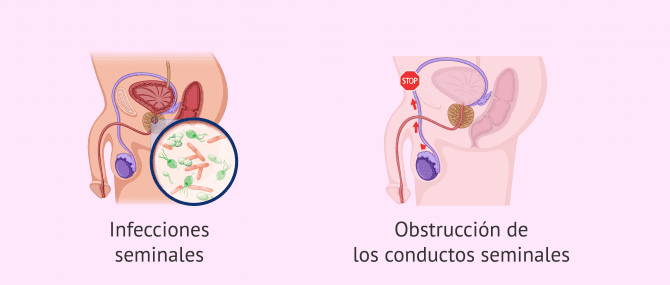 Imagen: Oligospermia por causas postesticulares