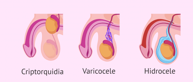 Imagen: Oligospermia por causas testiculares