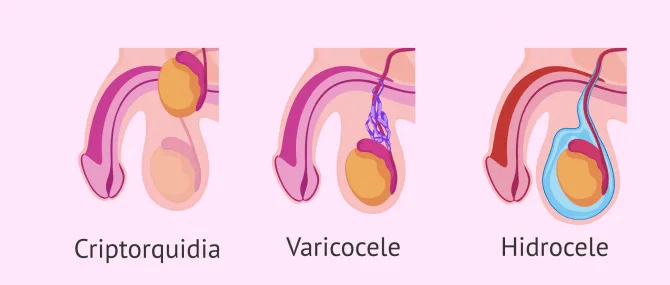 Imagen: Oligospermia por causas testiculares