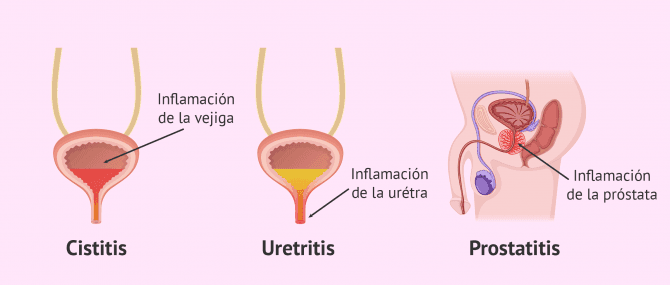 Imagen: Infecciones urinarias de las vías bajas