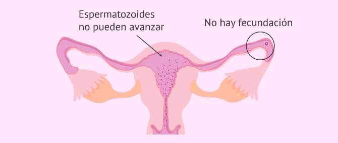 Imagen: Llegada de los espermatozoides al ovocito