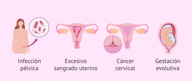 Imagen: Contraindicaciones de la histeroscopia