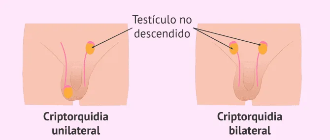 Imagen: Criptorquidia y fertilidad