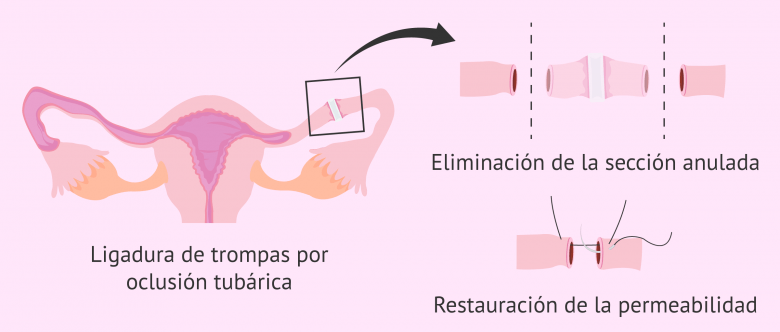 Imagen: Revertir la ligadura
