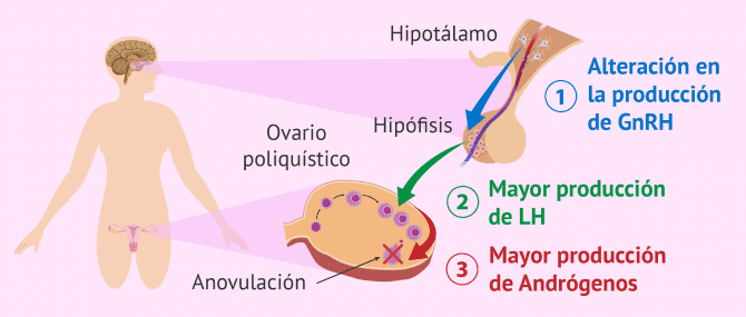 Imagen: Desorden hipotalámico causante de SOP