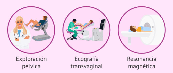 Imagen: Técnicas para diagnóstico de la adenomiosis