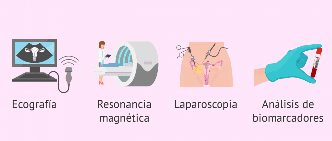 Imagen: Cómo se diagnostica la endometriosis