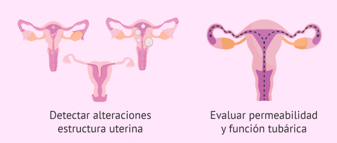 Imagen: ¿Qué detecta la HyCoSy?