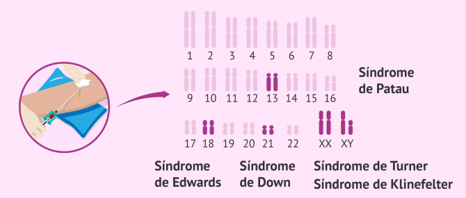 Imagen: Diagnóstico prenatal no invasivo en sangre materna