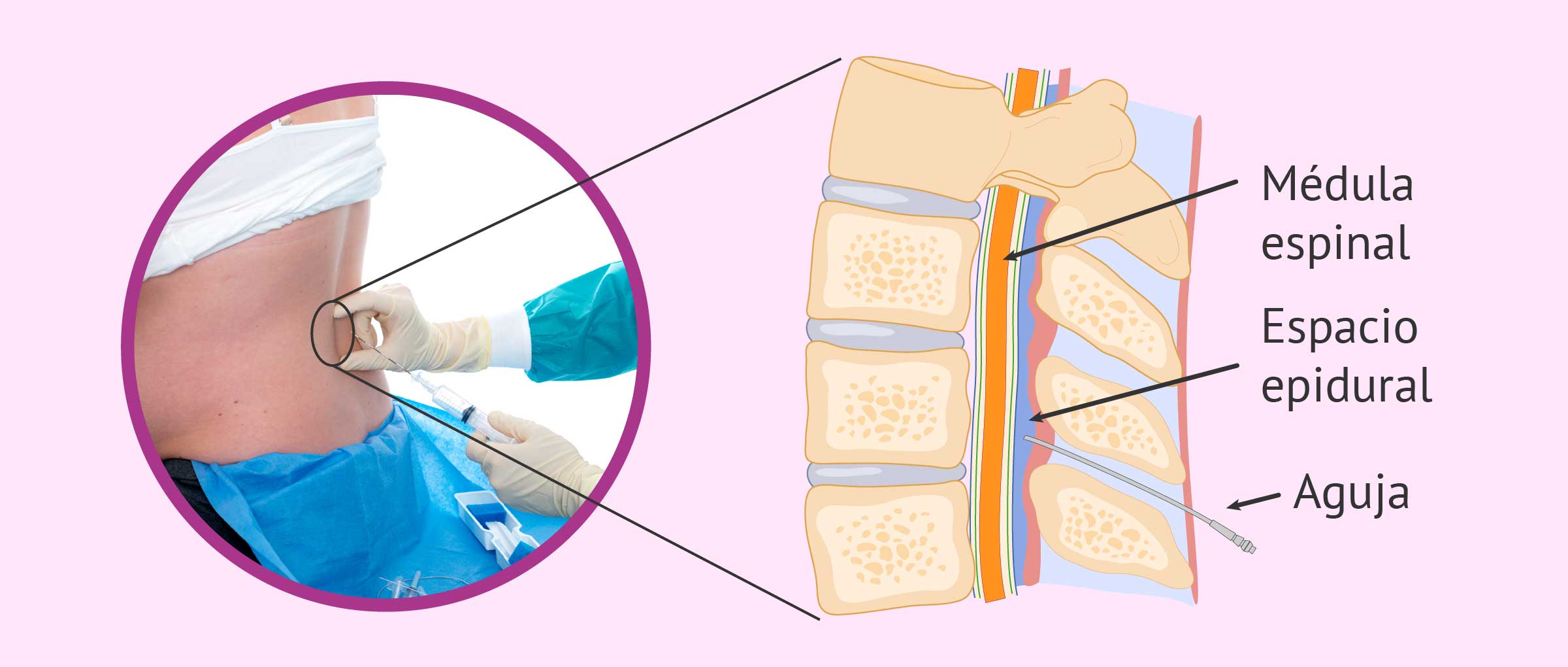 La Anestesia Epidural En El Parto Ventajas Y Desventajas