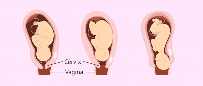 Imagen: El parto vaginal