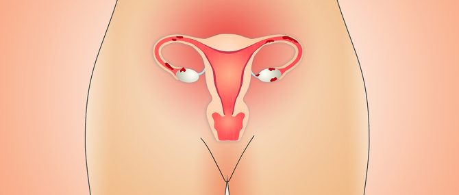 Imagen: La endometriosis