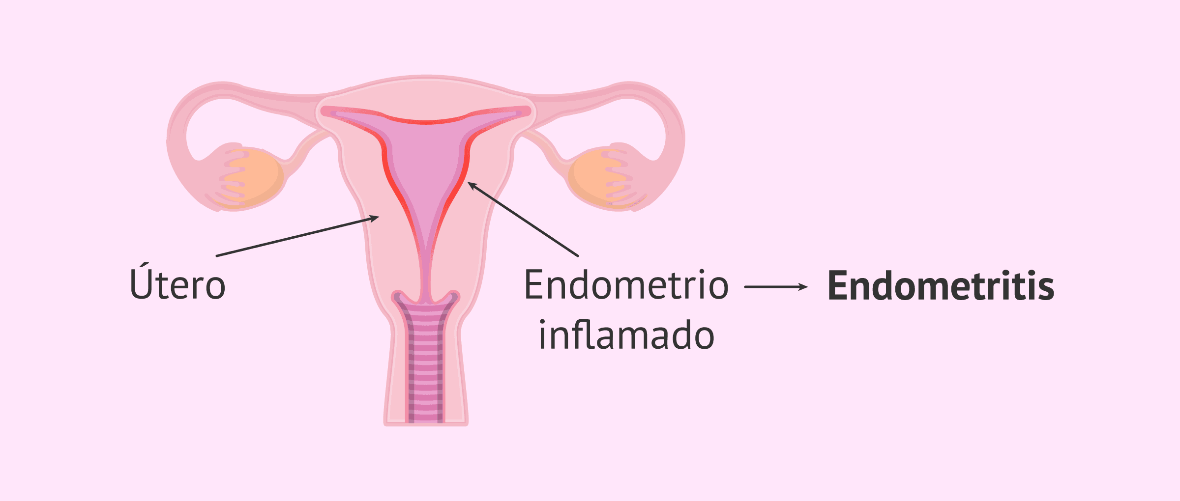 Imagen: Endometritis o inflamación del endometrio