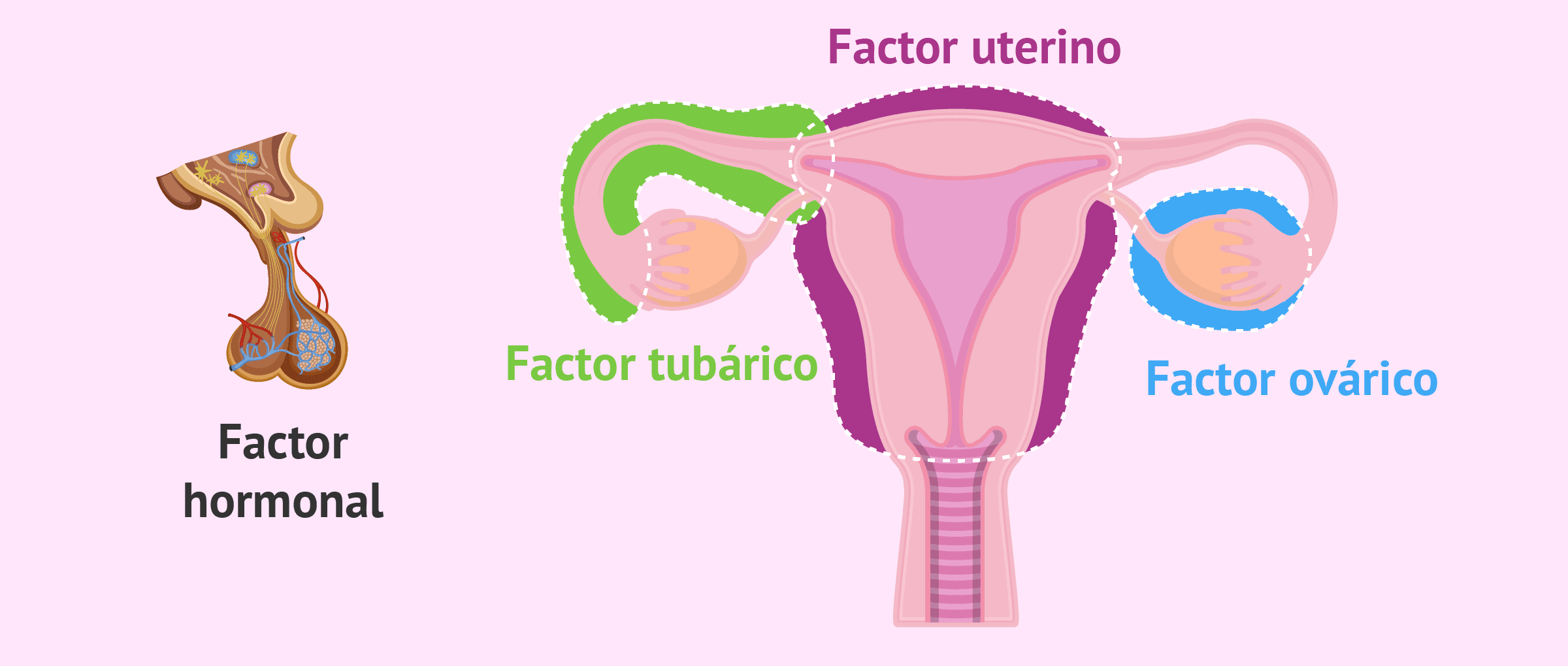 Enfermedades que producen infertilidad femenina