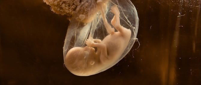 Imagen: Estenosis aórtica crítica