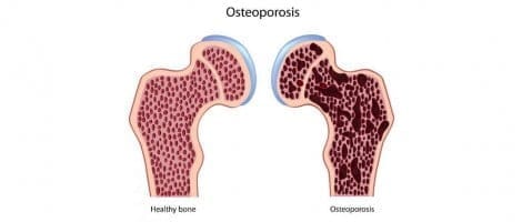 Estrógenos protegen de la osteoporosis