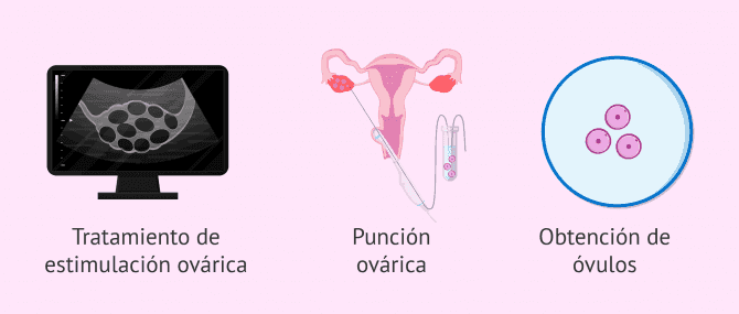 Imagen: Punción folicular para extraer los ovocitos