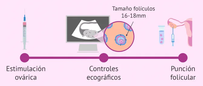 Imagen: Pasos de la donación de óvulos
