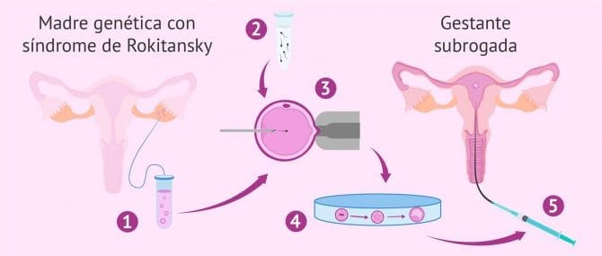 Imagen: Gestación subrogada en mujeres con el síndrome de Rokitansky