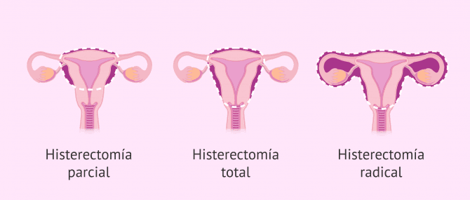 Imagen: histerectomia-tipos-glosario