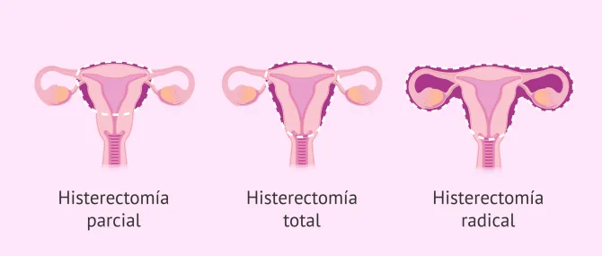 Imagen: histerectomia-tipos-glosario