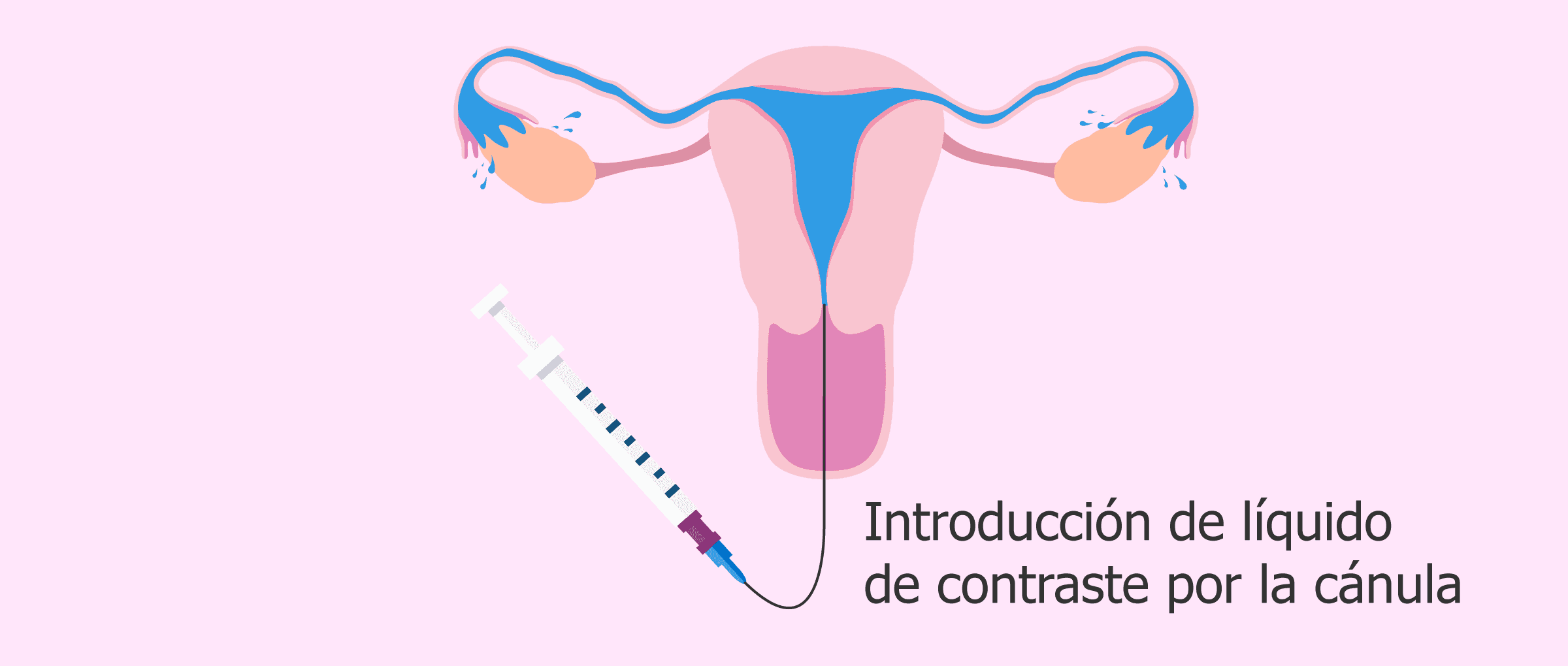 Histerosalpingografía para diagnosticar Asherman
